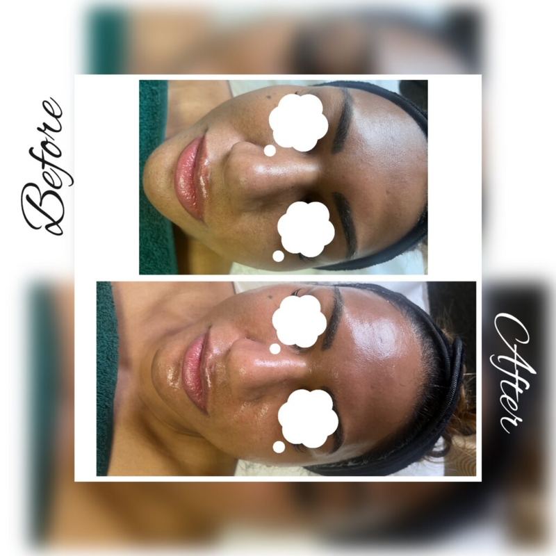 Before and after: facial skin tone